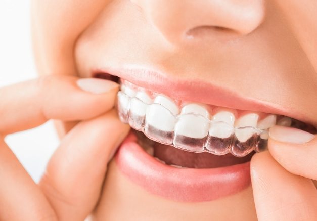 Invisalign treatment image