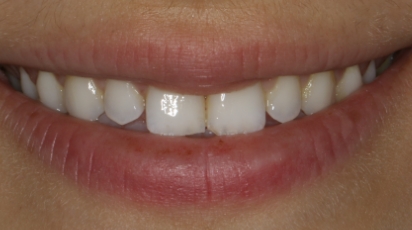 Testimonials Smiles before image