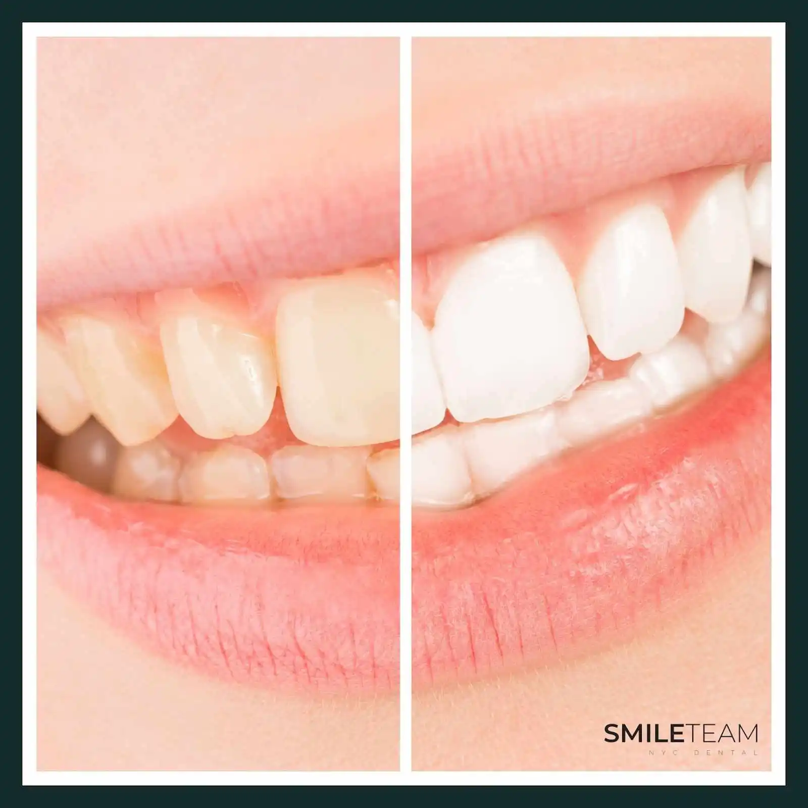 Are Your Teeth Ready for Teeth Whitening Treatment