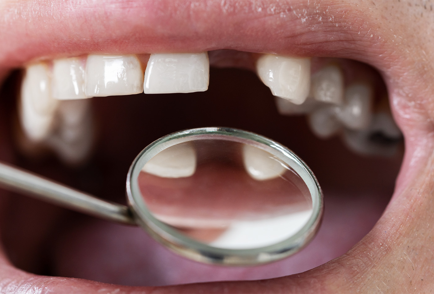 Restoring Your Smile: How to Replace a Missing Tooth?