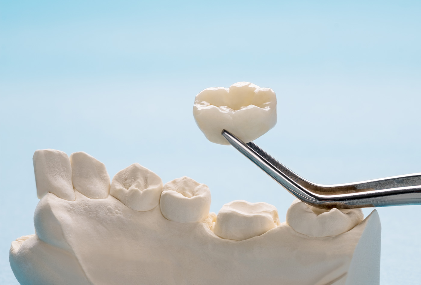Which Types of Dental Crown Material Are Right for You?